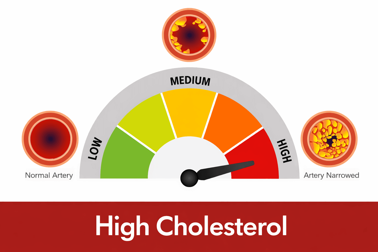 What Are the 10 Warning Signs of High Cholesterol?