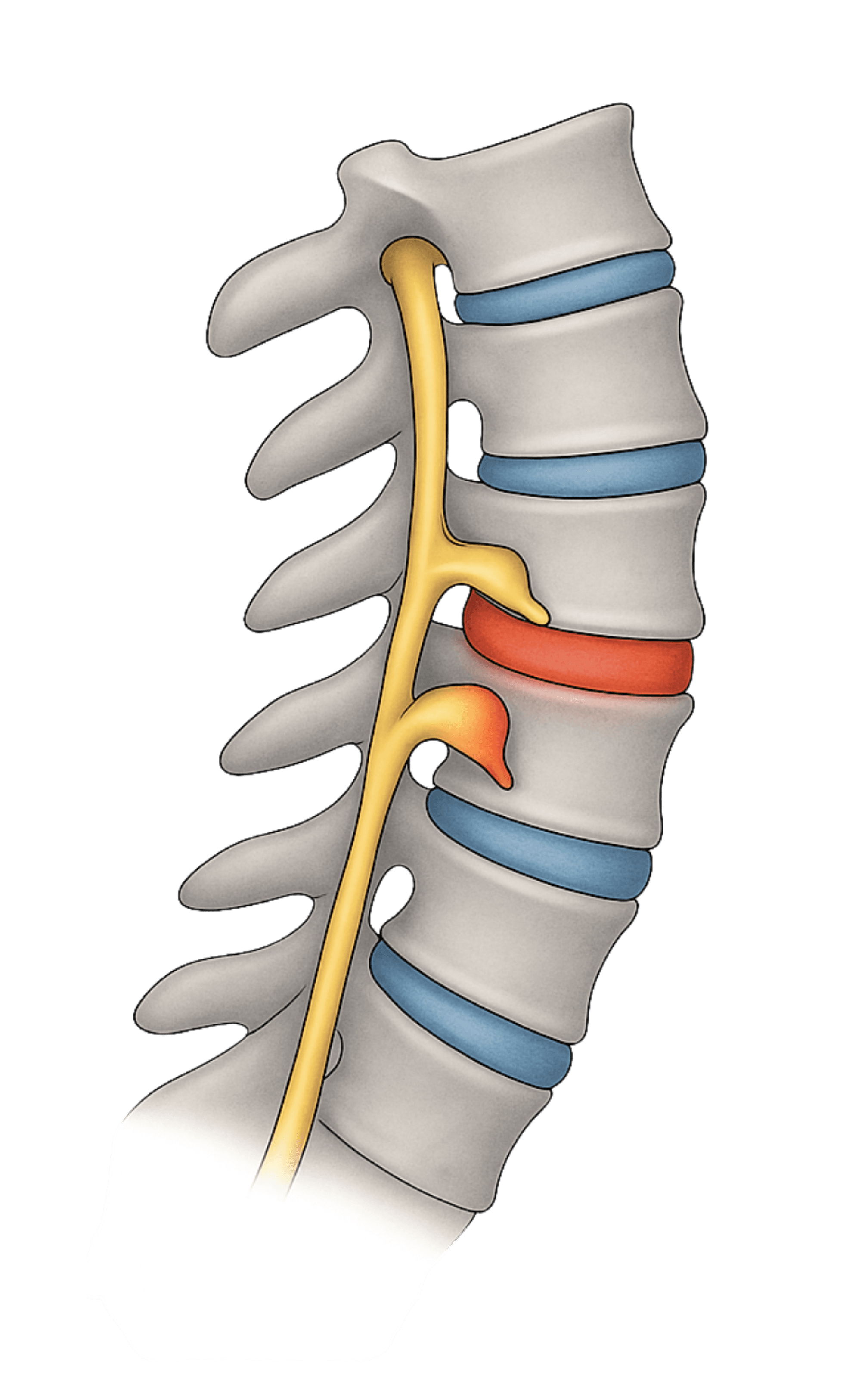 Nerve or Spinal Cord Compression