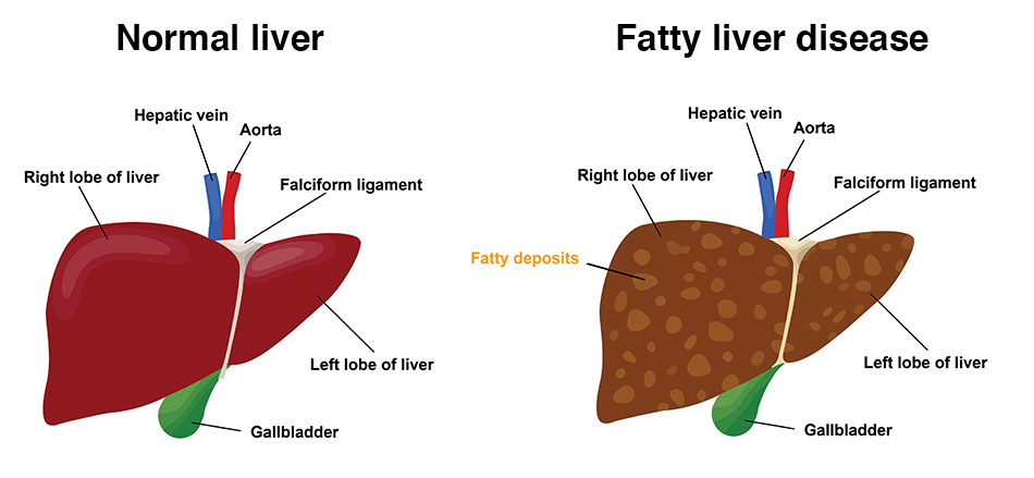 Fatty liver
